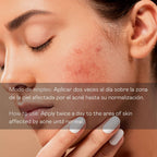 Sérum Facial Antiimperfecciones Directo – Acción Intensiva - 30 ml Valquer®